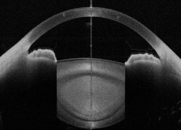 CASIA2による前眼部断面図